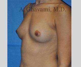 Breast Augmentation Before & After Patient #8915