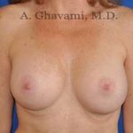 Breast Augmentation Before & After Patient #8910