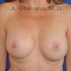 Breast Augmentation Before & After Patient #8910