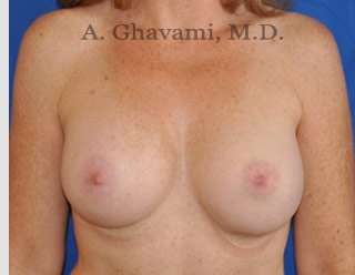 Breast Augmentation Before & After Patient #8910