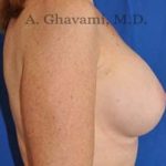 Breast Augmentation Before & After Patient #8910