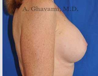 Breast Augmentation Before & After Patient #8910