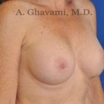 Breast Augmentation Before & After Patient #8910