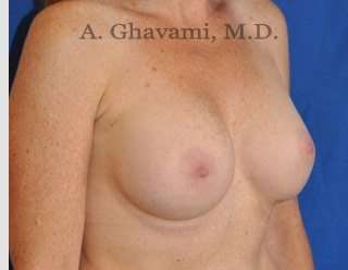 Breast Augmentation Before & After Patient #8910