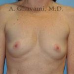 Breast Augmentation Before & After Patient #8910