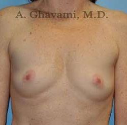 Breast Augmentation Before & After Patient #8910