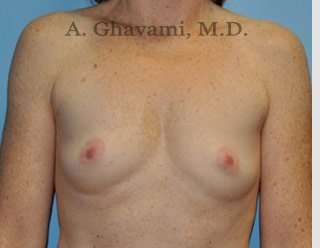 Breast Augmentation Before & After Patient #8910