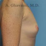 Breast Augmentation Before & After Patient #8910