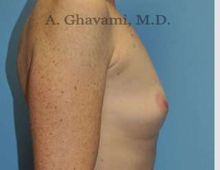 Breast Augmentation Before & After Patient #8910