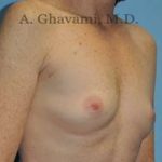 Breast Augmentation Before & After Patient #8910