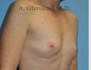 Breast Augmentation Before & After Patient #8910