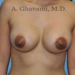 Breast Augmentation Before & After Patient #8903