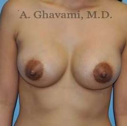 Breast Augmentation Before & After Patient #8903