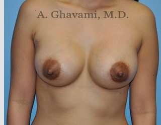 Breast Augmentation Before & After Patient #8903