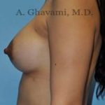 Breast Augmentation Before & After Patient #8903