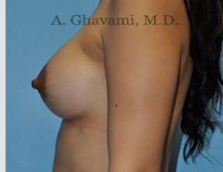 Breast Augmentation Before & After Patient #8903