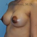 Breast Augmentation Before & After Patient #8903