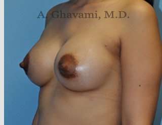 Breast Augmentation Before & After Patient #8903
