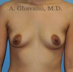 Breast Augmentation Before & After Patient #8903