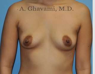 Breast Augmentation Before & After Patient #8903