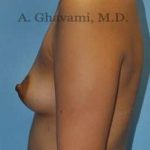 Breast Augmentation Before & After Patient #8903