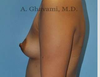 Breast Augmentation Before & After Patient #8903