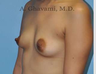 Breast Augmentation Before & After Patient #8903