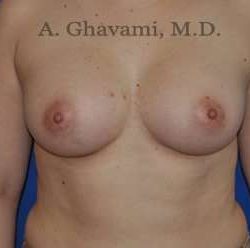 Breast Augmentation Before & After Patient #8896