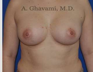 Breast Augmentation Before & After Patient #8896