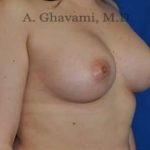 Breast Augmentation Before & After Patient #8896