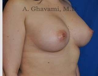 Breast Augmentation Before & After Patient #8896