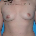 Breast Augmentation Before & After Patient #8896