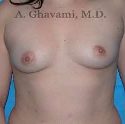 Breast Augmentation Before & After Patient #8896