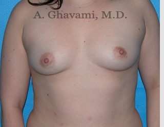 Breast Augmentation Before & After Patient #8896