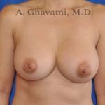 Breast Augmentation Before & After Patient #8891