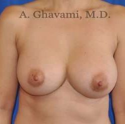 Breast Augmentation Before & After Patient #8891