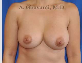 Breast Augmentation Before & After Patient #8891