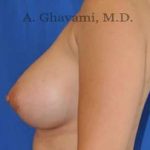 Breast Augmentation Before & After Patient #8891