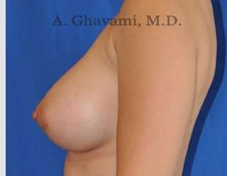 Breast Augmentation Before & After Patient #8891