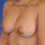 Breast Augmentation Before & After Patient #8891