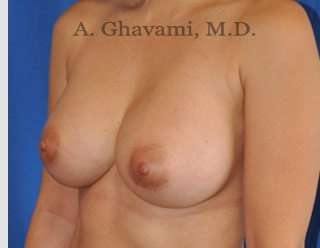 Breast Augmentation Before & After Patient #8891