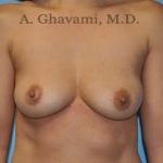 Breast Augmentation Before & After Patient #8891