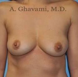 Breast Augmentation Before & After Patient #8891