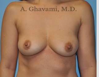 Breast Augmentation Before & After Patient #8891