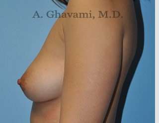 Breast Augmentation Before & After Patient #8891