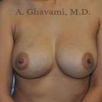 Breast Augmentation Before & After Patient #8884