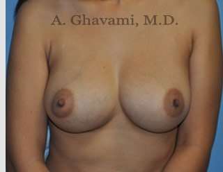 Breast Augmentation Before & After Patient #8884