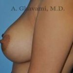 Breast Augmentation Before & After Patient #8884