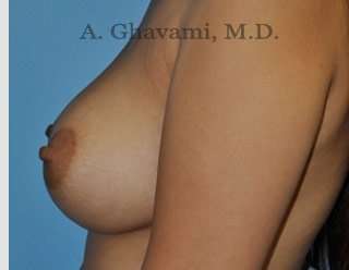 Breast Augmentation Before & After Patient #8884