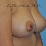 Breast Augmentation Before & After Patient #8884